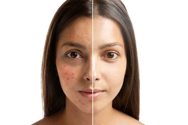 Acne-Treatment-Danville-CA
